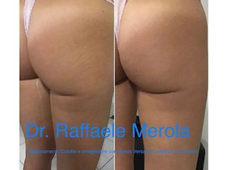 Cellulite - Dott. Raffaele Merola