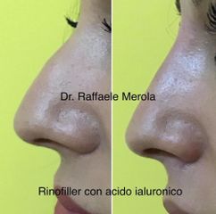 Rinofiller - Dott. Raffaele Merola