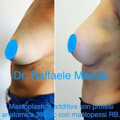 Mastoplastica additiva - Dott. Raffaele Merola
