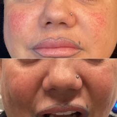 Edonise Laser Medical Remove Rosacea