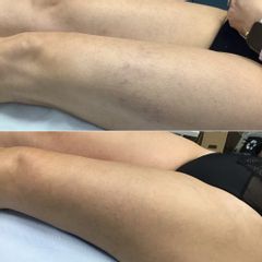 Edonise Laser Medical Remove Risultati del trattamento rimozione capillari
