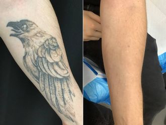 Rimozione tatuaggi prima e dopo - 879434