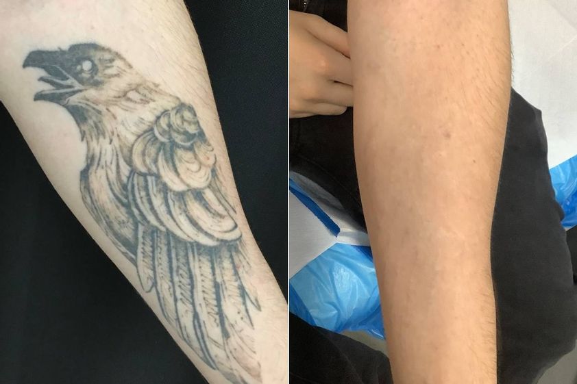 Rimozione tatuaggi prima e dopo - 879434