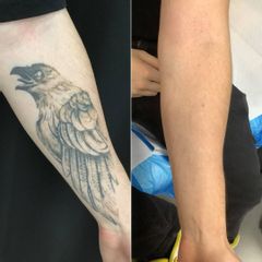 Edonise Laser Medical Remove Risultati del trattamento rimozione tatuaggi