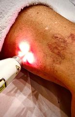 Laser vascolare per la rimozione di vasi capillari e vene