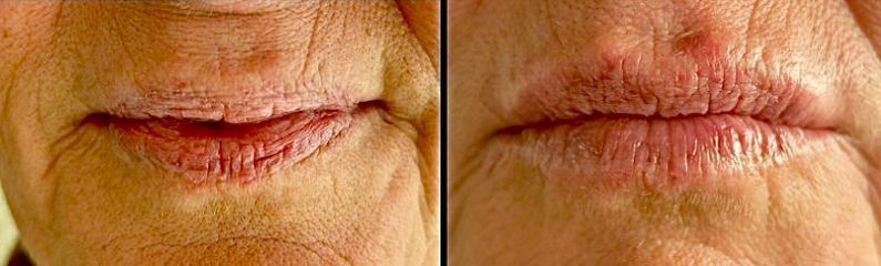 Dott.ssa Cornelia Florea Filler Labbra