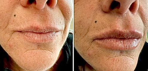 Dott.ssa Cornelia Florea Filler Labbra