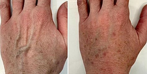 Dott.ssa Cornelia Florea Macchie pelle