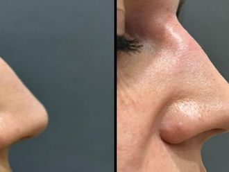 Rinofiller prima e dopo - 876519