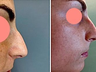 Rinofiller prima e dopo - 876520