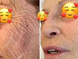 Rughe prima e dopo - 876521