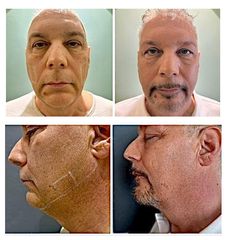 Dott.ssa Cornelia Florea Acido Polilattico e Filler