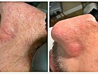 Capillari prima e dopo - 876547