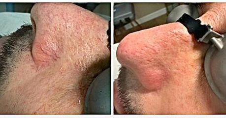 Dott.ssa Cornelia Florea Laser Capillari