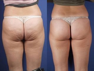 Cellulite prima e dopo