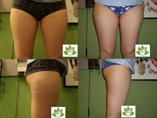Cellulite prima e dopo