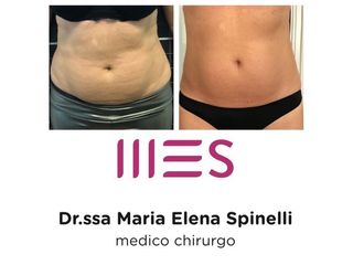 Criolipolisi - Medicina Estetica Spinelli