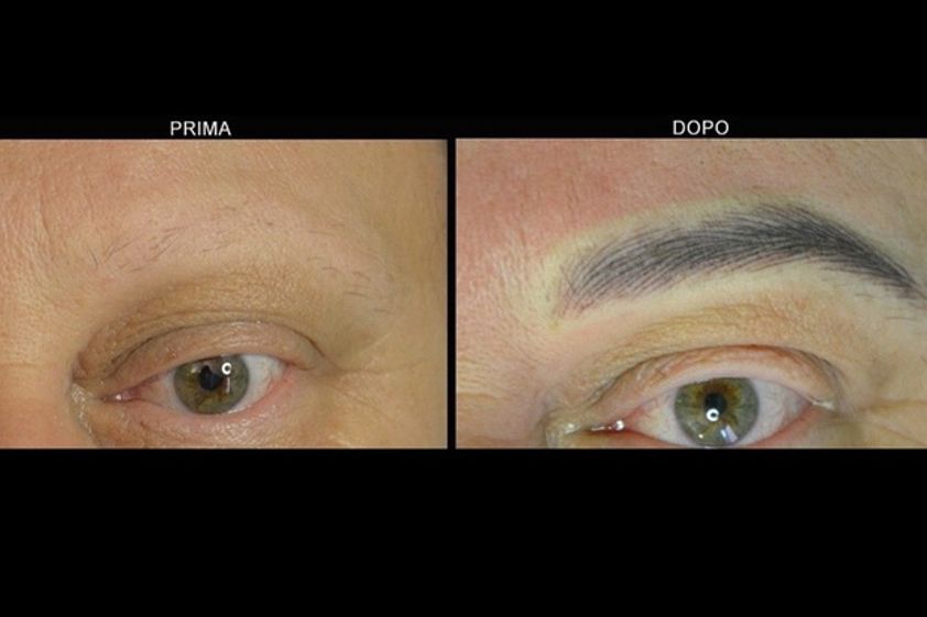 Tricopigmentazione prima e dopo - 756952