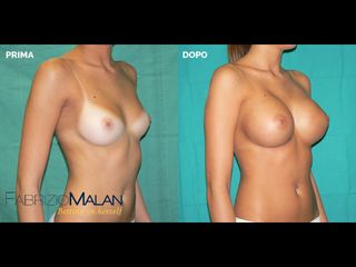 Mastoplastica additiva - Studio Medico Malan