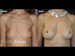 Mastoplastica additiva - Studio Medico Malan