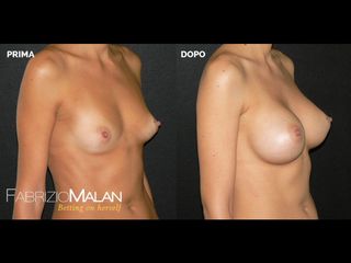 Mastoplastica additiva - Studio Medico Malan