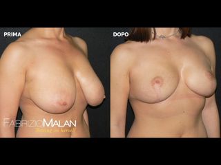 Mastoplastica riduttiva - Studio Medico Malan
