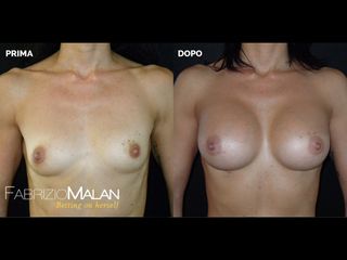 Mastoplastica additiva - Studio Medico Malan
