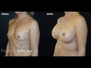 Mastoplastica additiva - Studio Medico Malan
