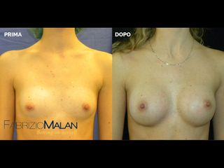 Mastoplastica additiva - Studio Medico Malan