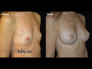 Mastoplastica additiva - Studio Medico Malan