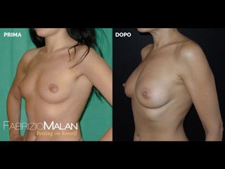 Mastoplastica additiva - Studio Medico Malan