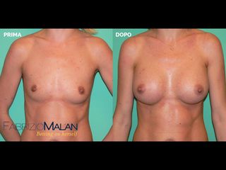 Mastoplastica additiva - Studio Medico Malan