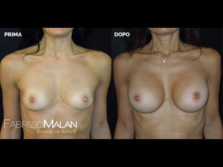 Mastoplastica additiva - Studio Medico Malan