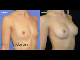 Mastoplastica additiva - Studio Medico Malan