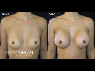 Mastoplastica additiva - Studio Medico Malan