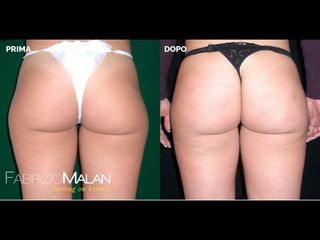Gluteoplastica - Studio Medico Malan