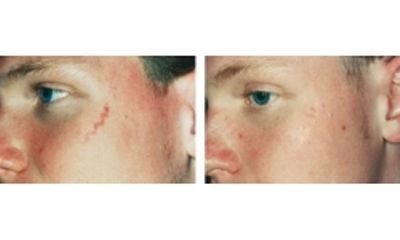 Cicatrici prima e dopo