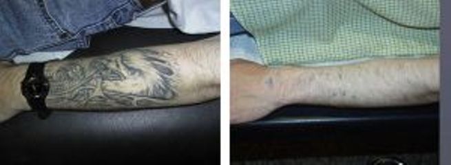 Tatuaggio prima e dopo
