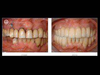 Riabilitazione protesica prima e dopo