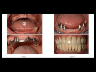 Riabilitazione protesica prima e dopo