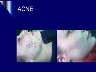 acne prima dopo