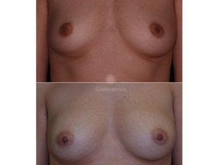 lipofilling prima dopo