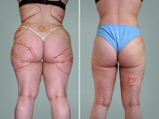 Lipo Laser System prima e dopo