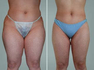 Lipo Laser System prima e dopo