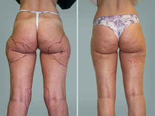 Lipo Laser System prima e dopo