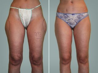 Lipo Laser System prima e dopo