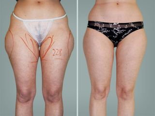 Lipo Laser System prima e dopo