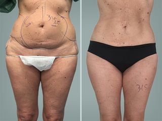 Lipo Laser System prima e dopo