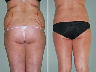 Lipo Laser System prima e dopo