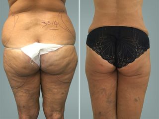 Lipo Laser System prima e dopo
